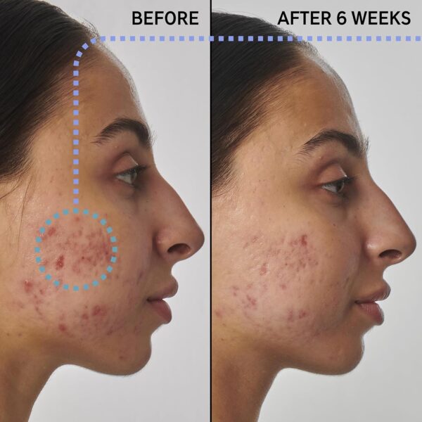 The INKEY List SuperSolutions 1% Retinol Serum for Face and Neck, Helps with Scar, Wrinkle and Skin Tone Appearance for Healthy-Looking Skin, 1.01 fl oz - Image 6